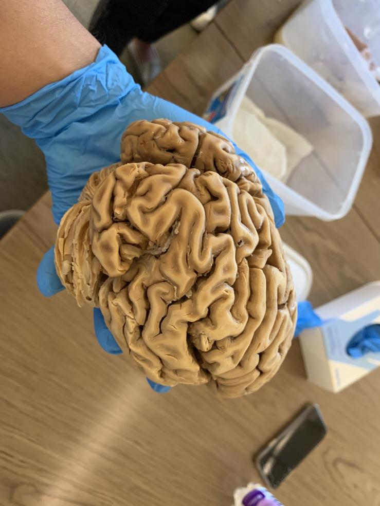 Picture of a gloved hand with a preserved brain